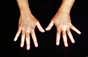 Contact dermatitis exposure to hydroquinone, a popular component used in skin bleach products